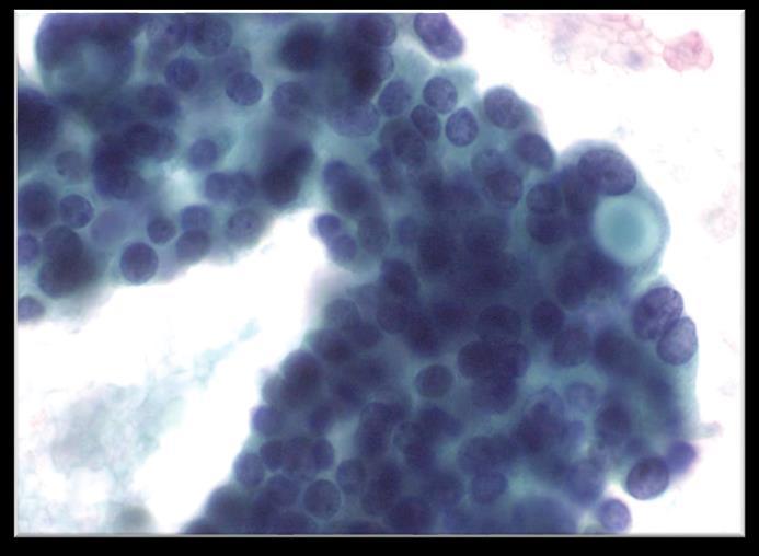 epithelioid tumor cells with pleomorphic nuclei, often admixed with more