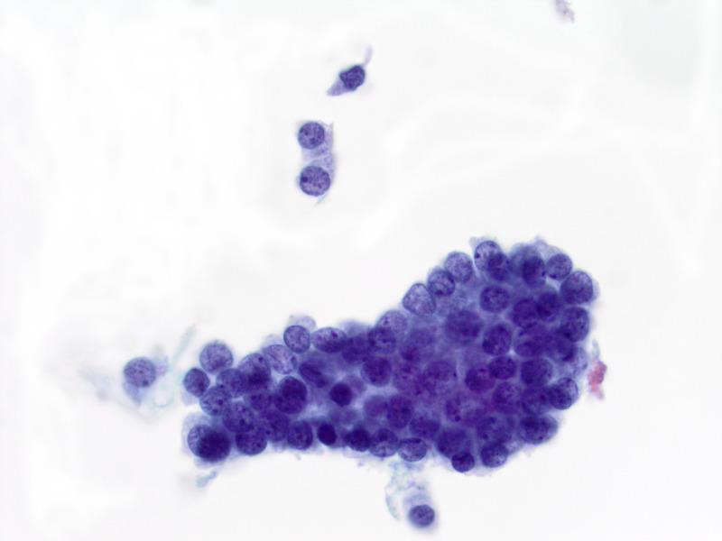 3. Cytologic & Architectural Atypia The presence of both mild cytologic and architectural atypia may be more