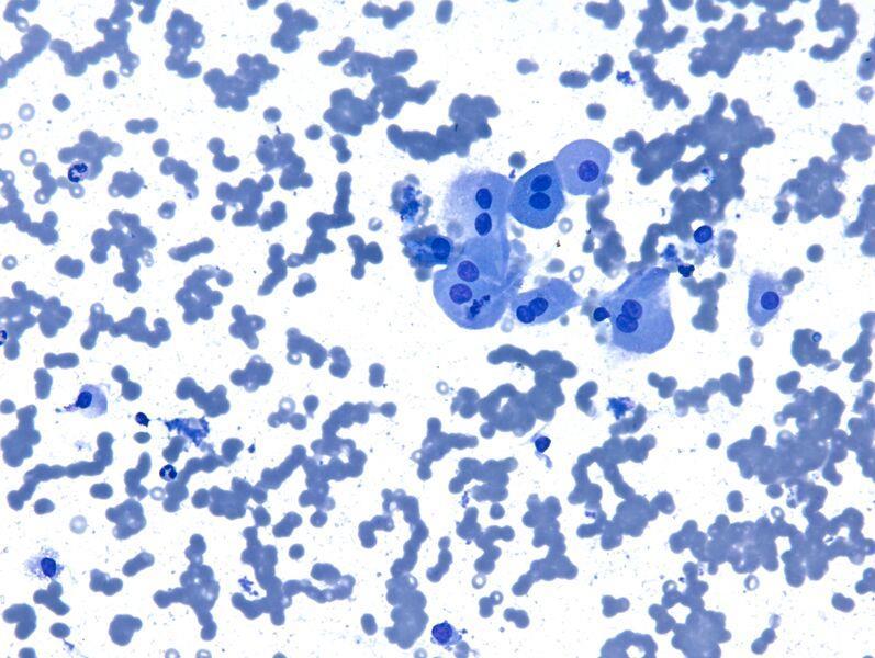 4. Hürthle cell aspirates A sparsely cellular aspirate