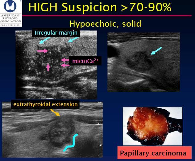 Risk stratification by sonographic patterns Pure cyst Mixed cystic/