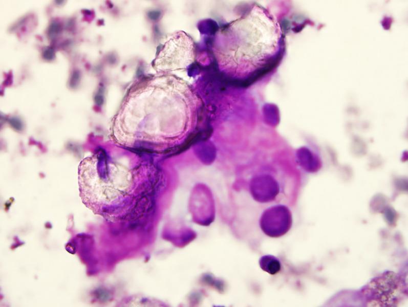 Papillary hyperplasia without nuclear cytologic features