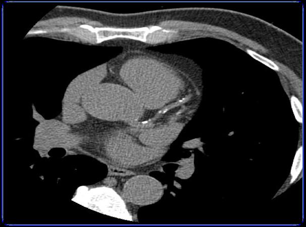 Coronary Computed Tomography