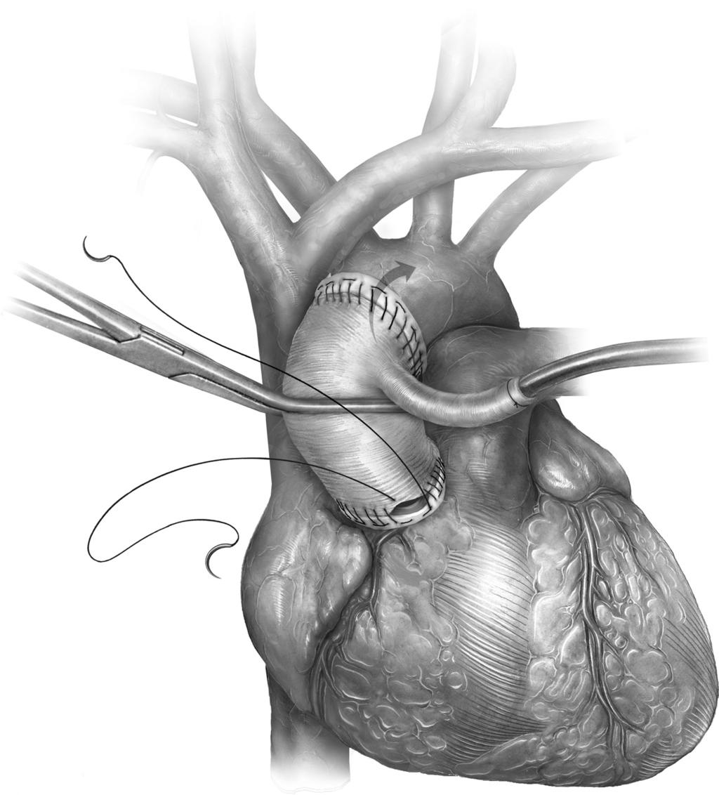 Acute type A aortic dissection 133 Figure 9 This figure depicts the completion of the anatomic repair.