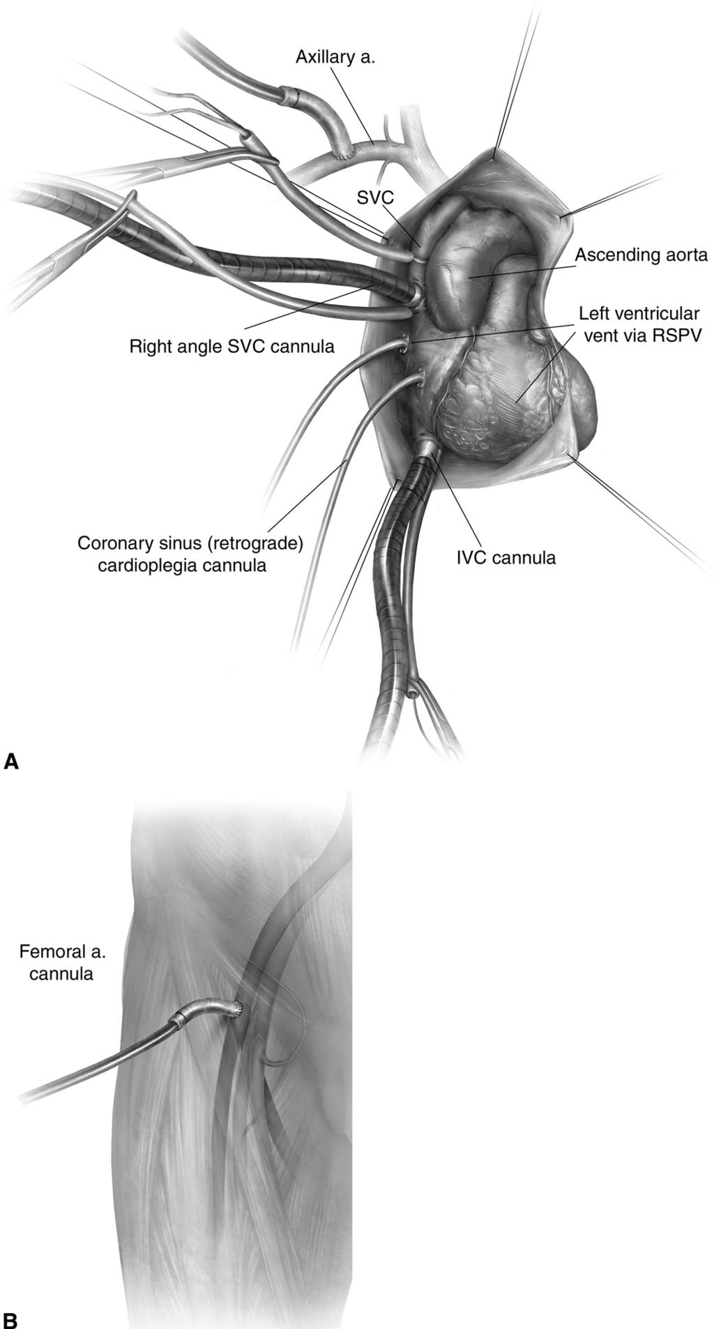 126 R.M. Bolman, III Figure 2 This figure demonstrates the cannulation for bypass. Either the axillary artery (A) or the femoral artery with the strongest pulse (B) can be cannulated.
