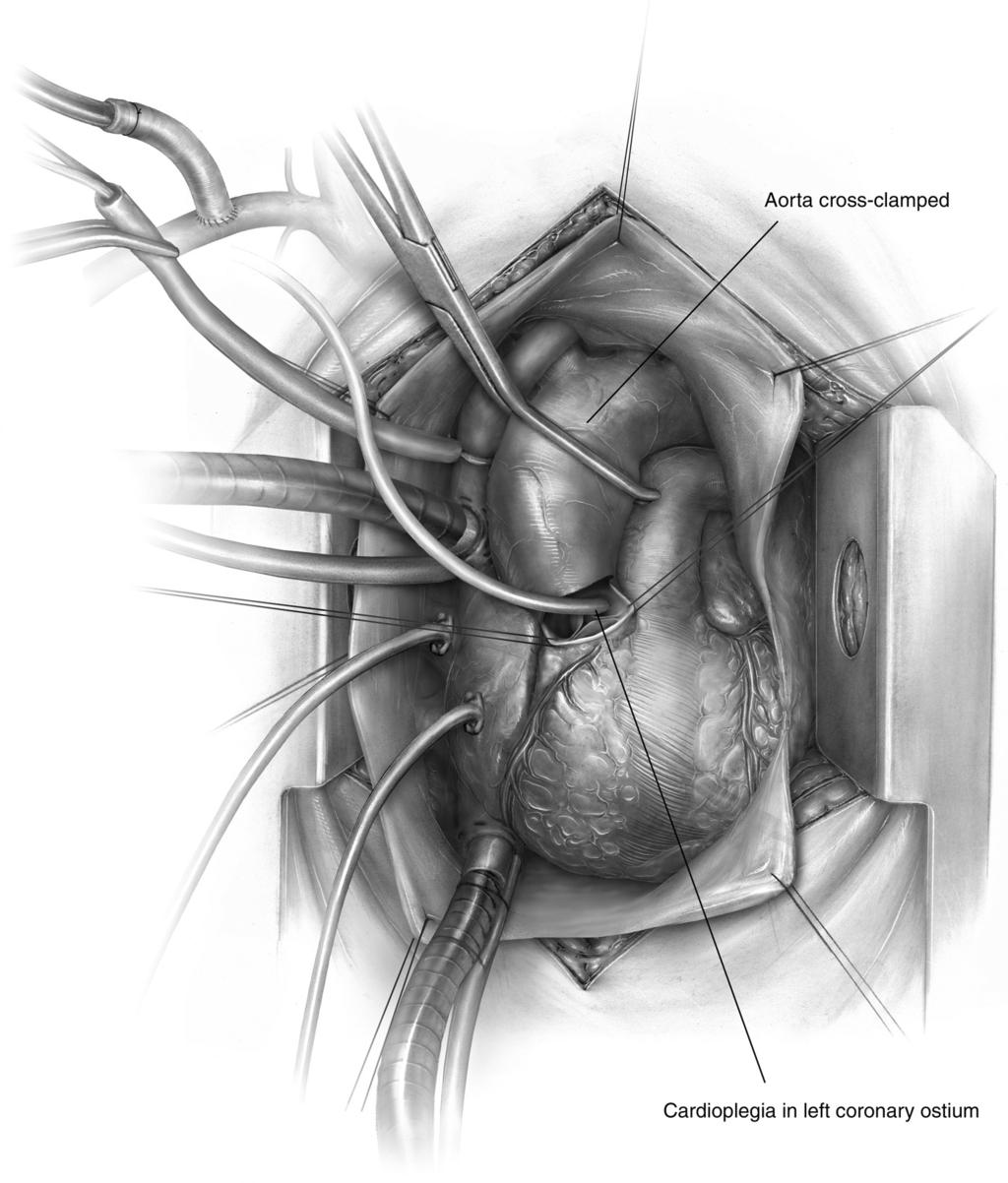 Acute type A aortic dissection 127 Figure 3 With the patient on bypass and the left ventricle vented, cooling can begin.