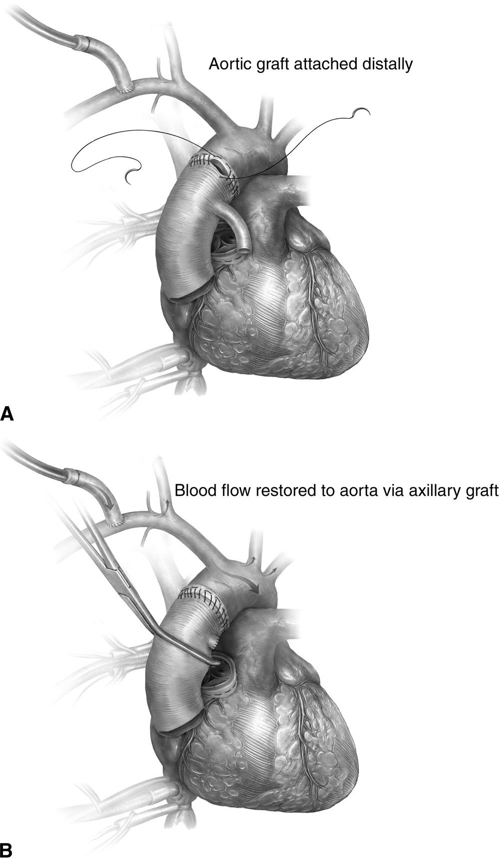 Acute type A aortic dissection 131 Figure 7 (A) The previously-chosen Dacron graft is brought to the field and anastomosed endto-end to the reconstructed distal ascending aorta using 2-0 or 3-0