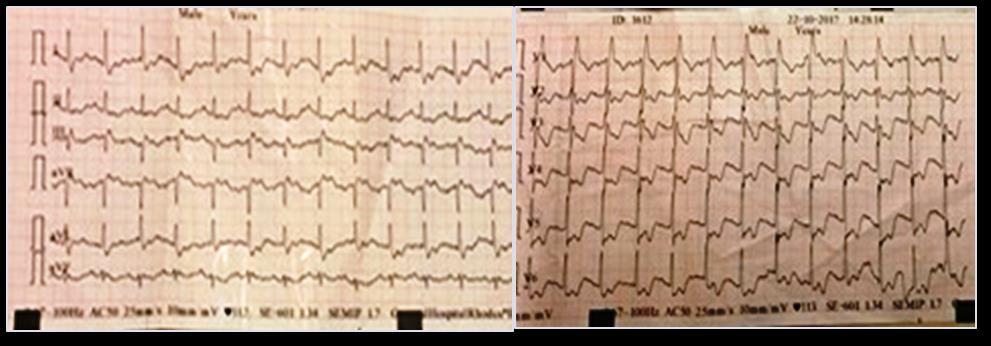 Diagnostic Investigation New ECG with signs of ischemia RBBB SR