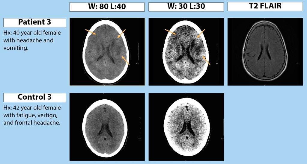 Fig. 2: Standard CT brain window (W:80 L:40) and narrow window (W:30 L:30) were provided for the artifact and control groups. MRI T2 FLAIR images were provided for the artifact group.