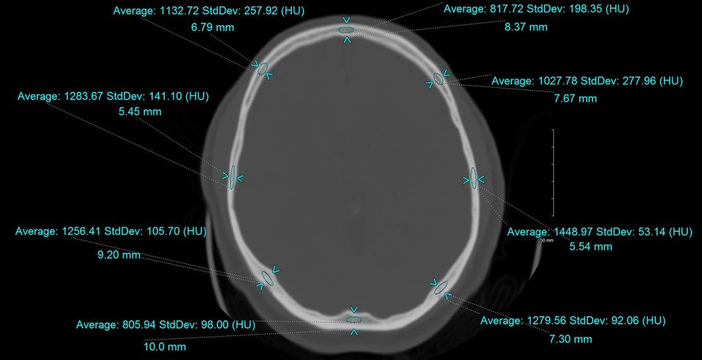 Fig. 3: Standard CT brain window (W:80 L:40) and narrow window (W:30 L:30) were provided for the artifact and control groups. MRI T2 FLAIR images were provided for the artifact group.