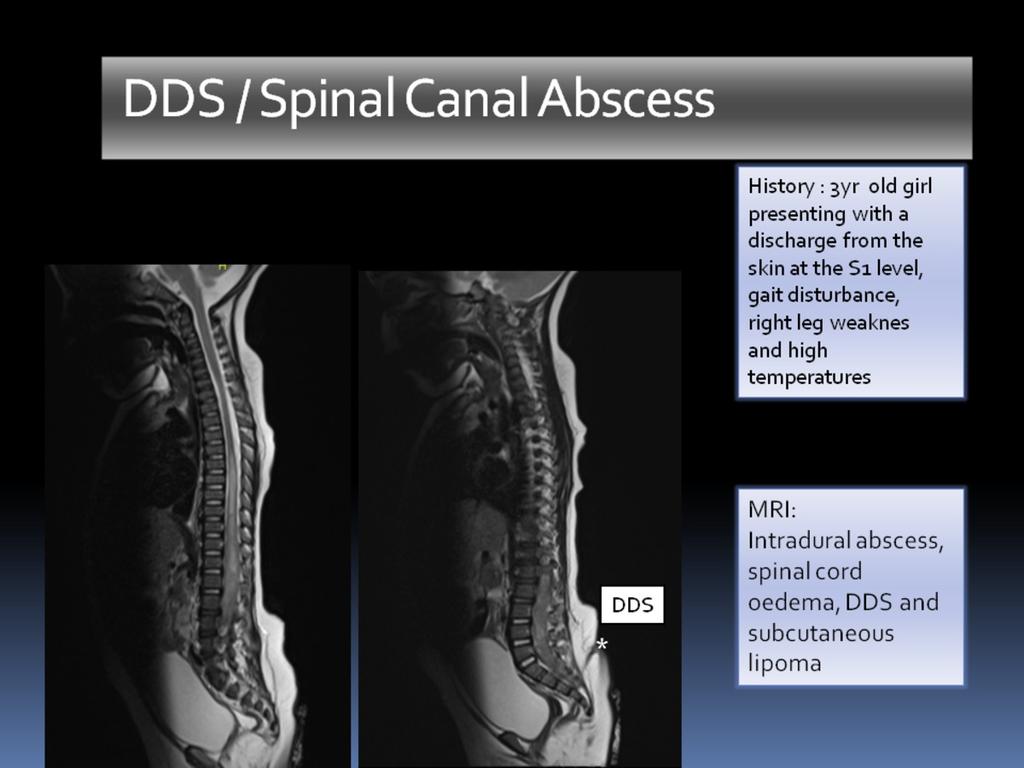 Fig. 9: MRI, sagittal T2 WI: DDS