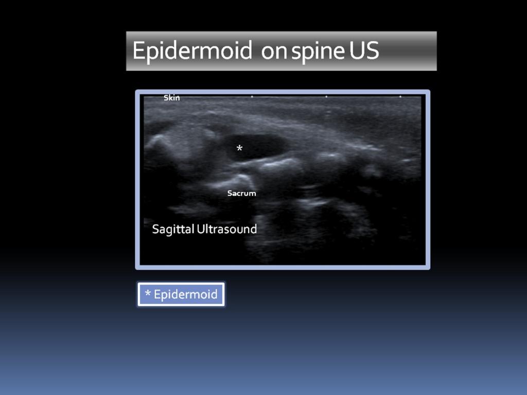 Fig. 13: US sagittal plane: Epidermoid shown