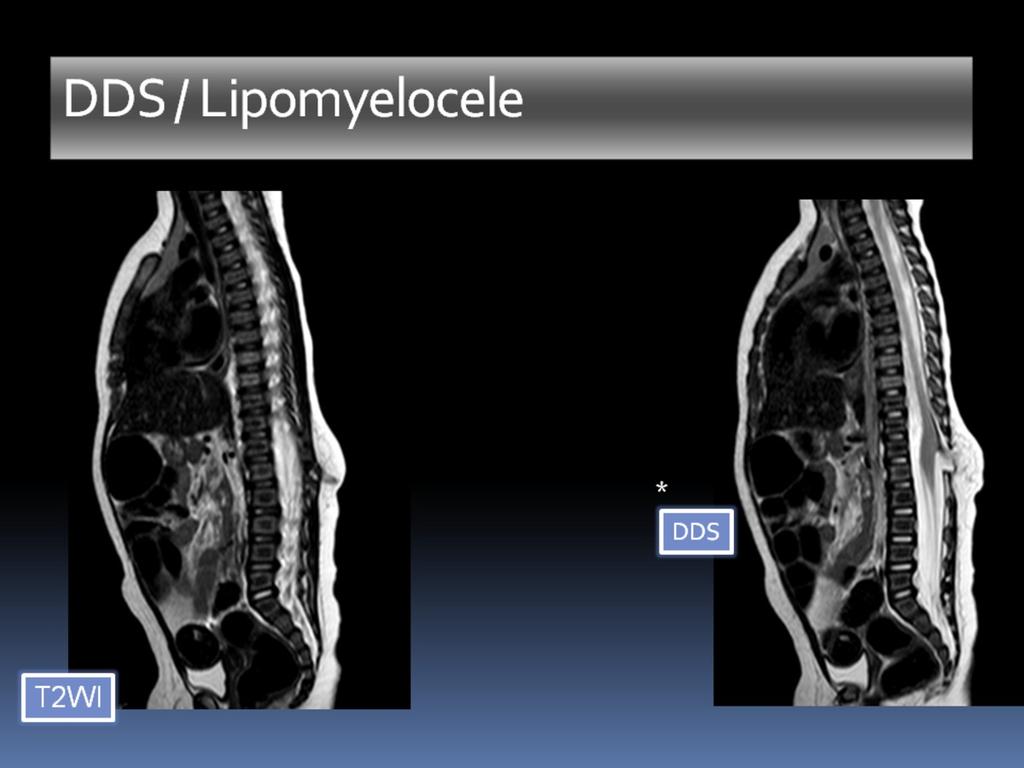 Fig. 14: MRI sagittal T2 WI: Hypointense DDS, bone defects,
