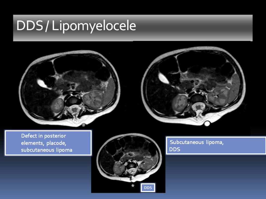 Fig. 15: MRI, Axial T2 WI: DDS