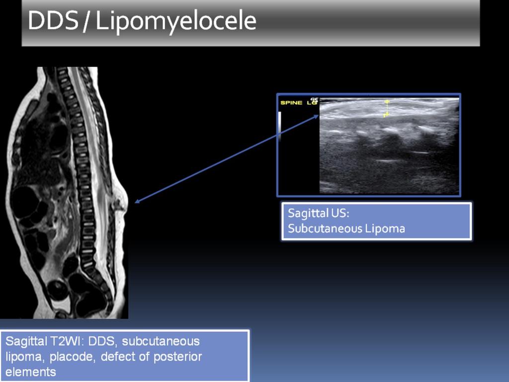 Fig. 16: MRI and US in the same patient with DDS and Lipomyelocele.