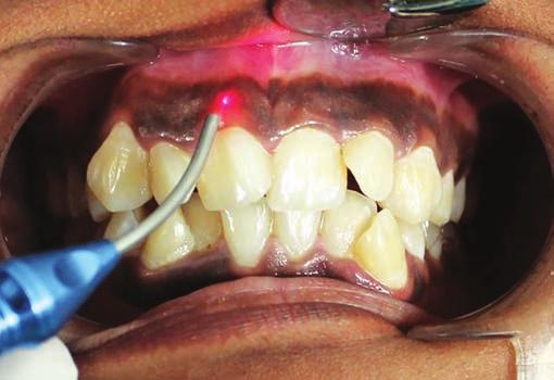 1) used in this study with continuous wavelength 810nm was applied at 3W of power via pencil sized hand piece containing a 300µm lasing fiber was used to gently remove the gingival epithelium along