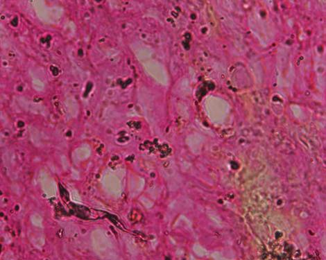 Laser ablation of pigmented epithelium immediately produced a melanin pigmentfree surface without any carbonization. The lased wound looked fresh with no bleeding.