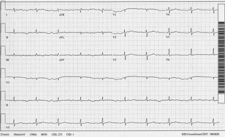 78 yo man with hx of HF presents with nausea Afib with AV Dissociation What