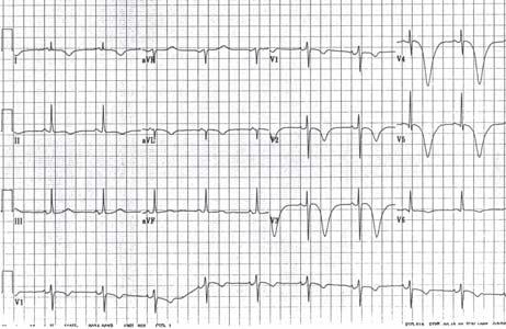 79 yo man admitted with CVA Diffuse ( Global ) T Wave Inversion Myocardial Ischemia (Evolving MI is focal) CNS event Apical HCM Pericarditis Myocarditis Takatsubo s Cardiomyopathy