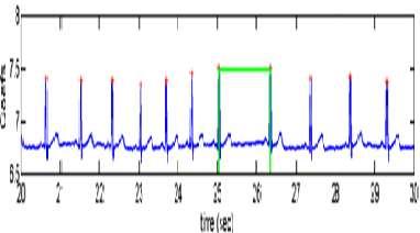 arrhythmia. Fig-6: Normal waveform Fig-7 shows the arrhythmia affected waveform.