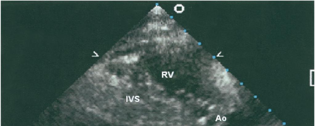 2D Echo Image from a Patient