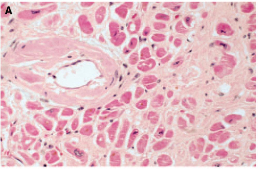 Diagnosis and Management of the Cardiac Amyloidoses A, Endomyocardial biopsy specimen, stained with hematoxylin and eosin,