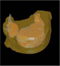 Cartilage Cortical Bone Spongiosa Marrow Trabecular Bone Bone Site Volume