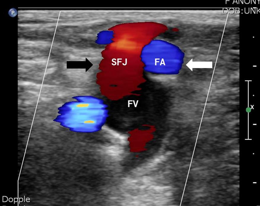 Anomalies During Varicose Vein Surgery Fig. 1. Femoral vessels complete transposition.