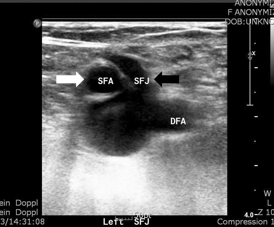 SFJ, saphenofemoral junction; SFA, superficial femoral artery; DFA, deep femoral artery. was connected to the superficial femoral vein.