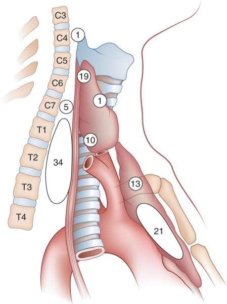 Sites of ectopic location of 104 parathyroid glands found at reoperation for primary