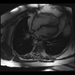 Cardiac MRI (age 41y) MRI