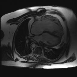 Cardiac MRI (age 48y) Mild PI, Severe TR (RF 63%) RVEDVi 278 ml/m 2, RVESVi 176 ml/m 2.