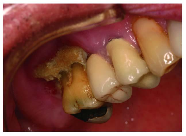 Osteonecrosis of the Jaw (ONJ) Bisphosphonate-Related Osteonecrosis of the Jaw Frequency: 1:1,700 to 1:20,000 Risk factors: