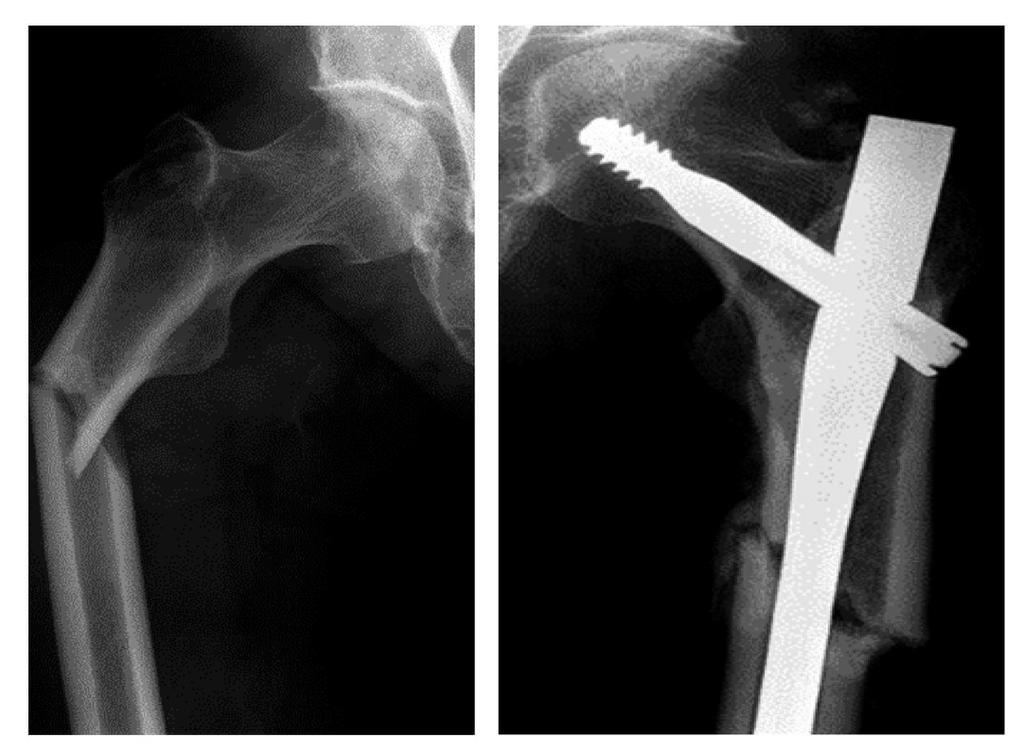 Atypical Subtrochanteric Femur Fracture Ask about new
