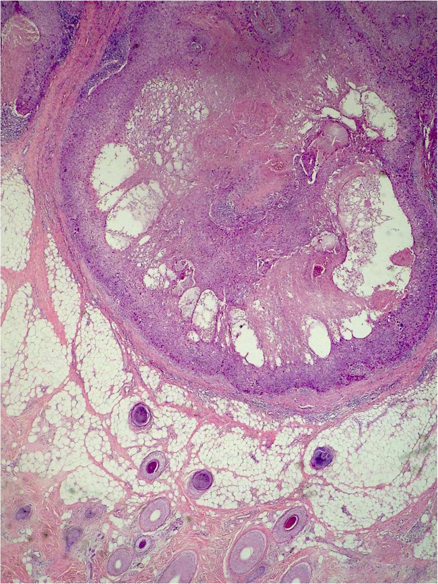Waqas et al. Journal of Medical Case Reports (2017) 11:67 Page 3 of 6 Fig. 1 Microcystic adnexal carcinoma: Deep dermis showing infiltrating tubules and cords with extension into the panniculus Fig.