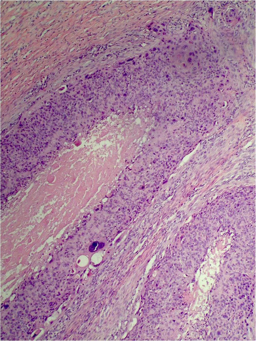 Waqas et al. Journal of Medical Case Reports (2017) 11:67 Page 4 of 6 Fig. 3 Pilomatrix carcinoma: Island and tumor with central cystic spaces located within the subcutaneous fat Fig.