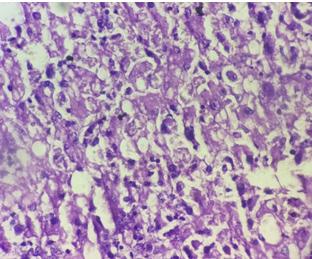 Fig. 3: Pilomatricoma Islands of tumor cells having both basophilic cells and shadow cells (H& E,