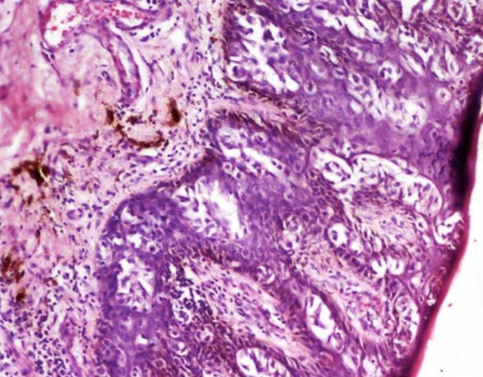 Figure 8: Pagets disease of breast showing large neoplastic cells with prominent nucleoli in the epidermis (HE Stain, X10).
