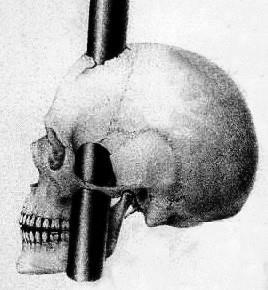 The Amazing Phineas Gage