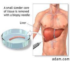 Diagnosing NAFLD with liver biopsy: a