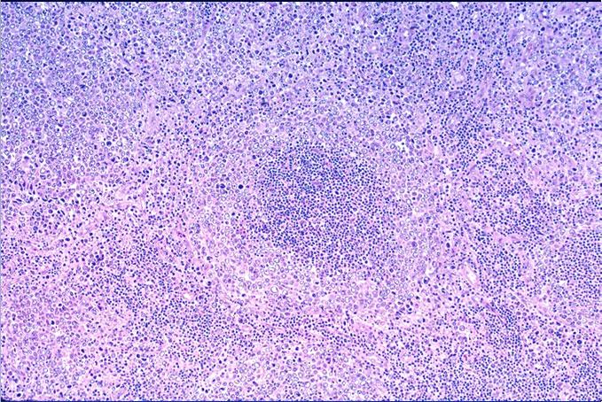 Angioimmunoblastic T- cell Lymphoma (AITL) Other 1. Mastocytosis 2.