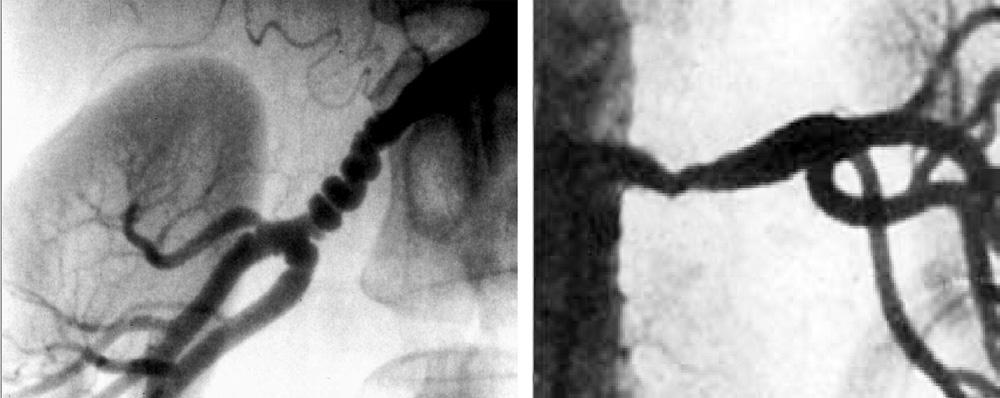 (medial fibroplasia). (Right) Atherosclerotic renal artery stenosis, characterized by stenosis of the ostium and proximal renal artery.