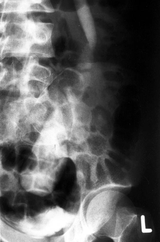 CASE PRESENTATION A 27-year-old man presented with sudden onset of sharp left loin accompanied by nausea and vomiting. The pain was worse on movement and was nonradiating.