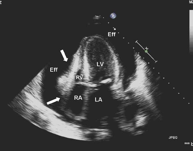 Pericardial Tamponade with Right-Sided
