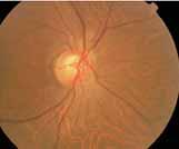 A B D C E Figure 1. A 50-year-old individual presents with elevated IOP, higher in the left eye, and optic discs that are average in size.