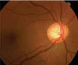 A B D C Figure 2. A 48-year-old patient presents with elevated IOP, higher in the right eye. The optic nerves are average in size.