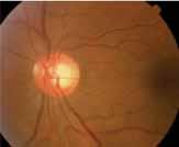 The field loss correlates with the optic nerve findings in the right eye (D).