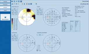 EyeSuite Visual Field Analysis Software: a Clinician s Experience BY JONATHAN MYERS, MD A year ago, my practice installed EyeSuite software (Haag- Streit USA Inc.