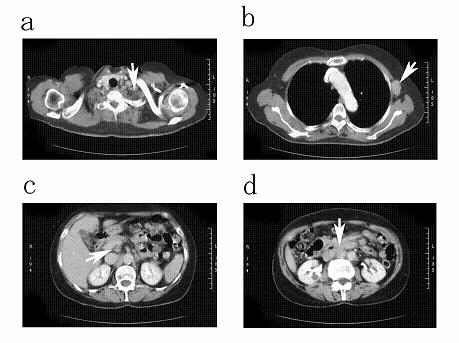 Fig. 1. CT images show lymph nodes swelling in; a: left cervical lymph nodes.