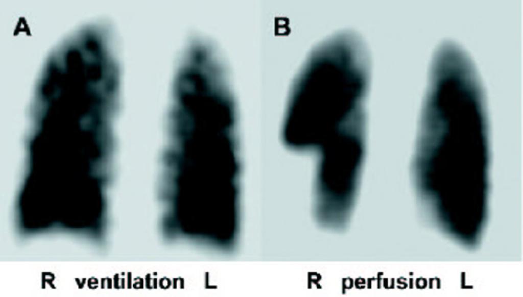 Fig. 4: VQ scan showing perfusion