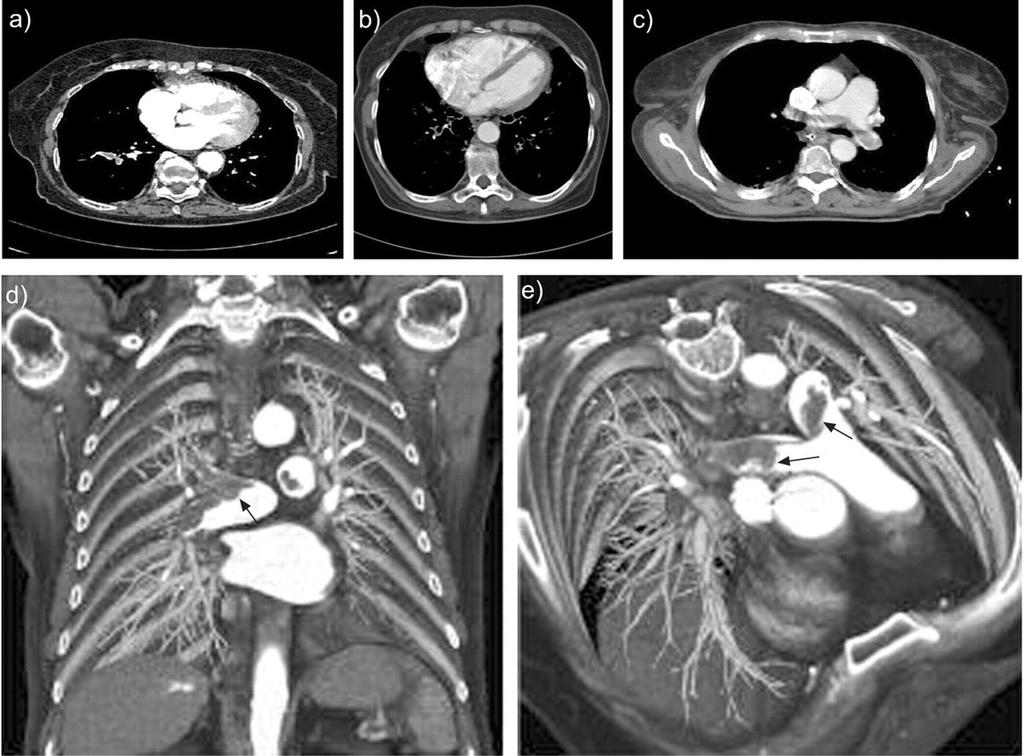 Fig. 5: Computed tomographic (CT) pulmonary angiography of acute pulmonary embolism (PE).